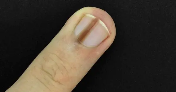 4 biểu hiện bất thường ở ngón tay giữa ngầm cảnh báo gan đang bị tổn thương